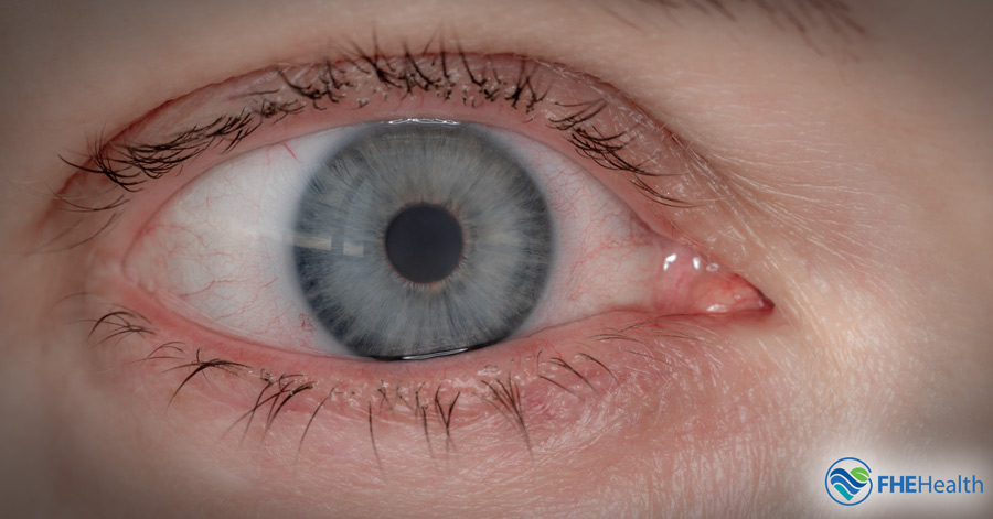 Eyes as Windows: Understanding Bloodshot Eyes and Dilated Pupils in Drug Abuse